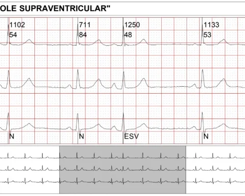 Tira de Holter con extrasístole supraventricular: latidos “N” y uno “ESV”, 56 lpm, velocidad 25 mm/s, derivaciones C1–C3.