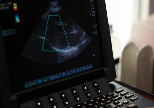 Pantalla de ecocardiograma en vista de 4 cámaras con Doppler color mostrando el flujo sanguíneo del corazón.